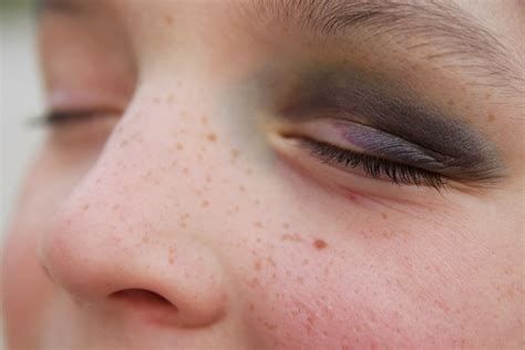 أفضل علاج لإزالة الكدمات من الوجه وتحت العين