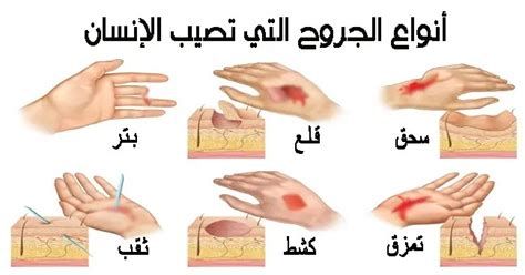 أفضل مضاد حيوي للجروح العميقة