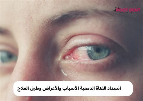 أفضل قطرة لعلاج جفاف العين