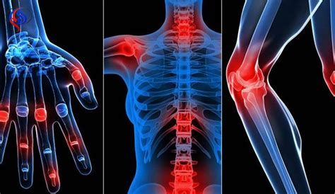 أفضل كريم لالتهاب المفاصل