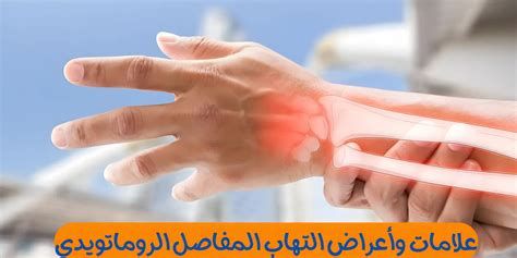 أفضل دواء لالتهاب المفاصل