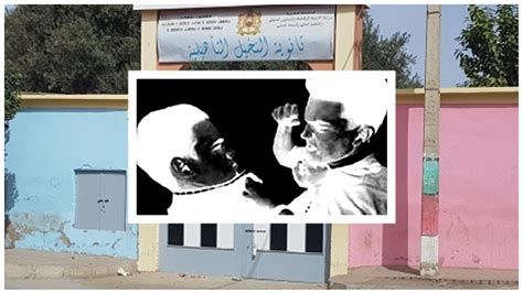 أفضل علاج لإزالة الكدمات من الوجه وتحت العين