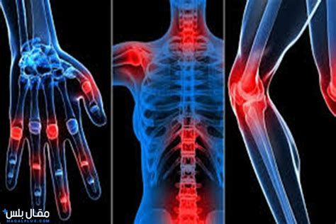 أفضل دواء لالتهاب المفاصل