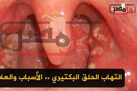 أفضل مضاد حيوي لالتهاب الحلق للأطفال