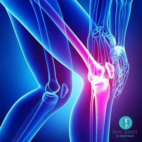 أفضل دواء لالتهاب المفاصل