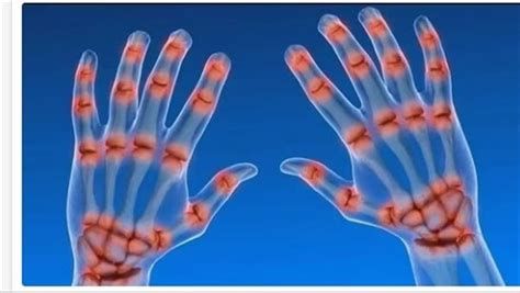 أفضل دواء لالتهاب المفاصل