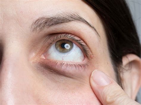 أفضل علاج لإزالة الكدمات من الوجه وتحت العين