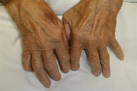 أفضل حبوب روماتيزم