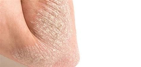 أعراض نقص فيتامين د في الجلد