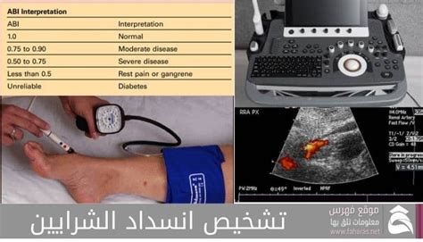 أعراض انسداد الشرايين عند النساء