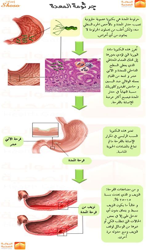 أعراض التهاب المعدة النفسية