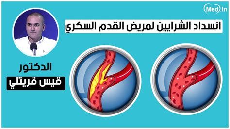 أعراض انسداد الشرايين عند النساء