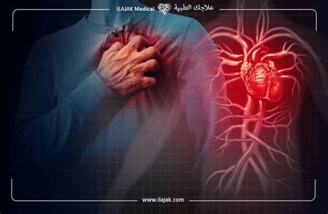 أعراض الذبحة الصدرية عند النساء