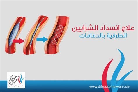 أعراض انسداد الشرايين عند النساء