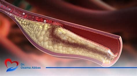 أعراض انسداد الشرايين عند النساء