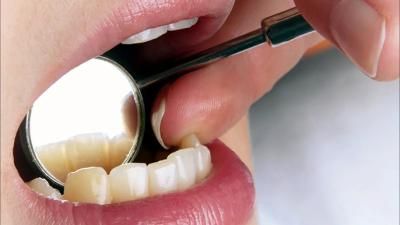 الأسباب المحتملة لنزيف اللثة