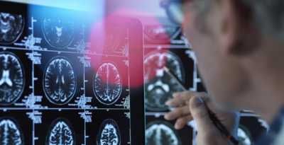 مؤشرات على الخرف قد تسبق التشخيص بعقود