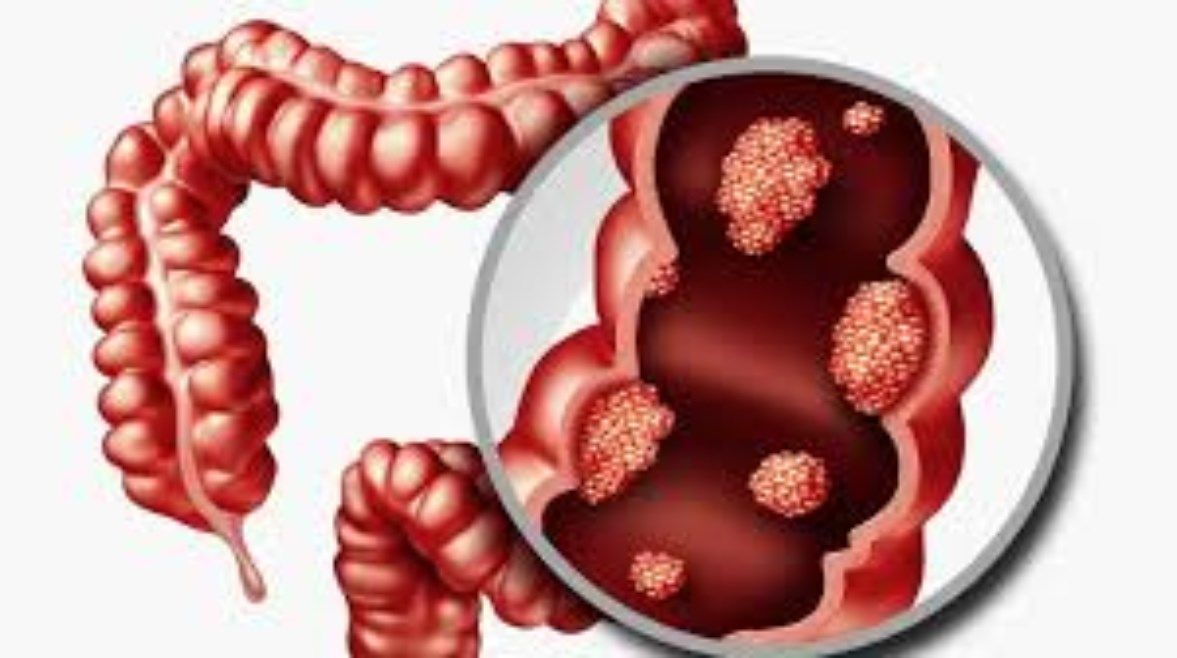 عاجل: يستهلكها الملايين.. قطعة واحدة من هذا الطعام قد تسبب الإصابة بالسرطان