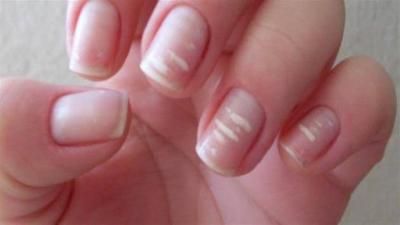 أخبار اليمن : 5 علامات "صامتة" لسرطان الجلد