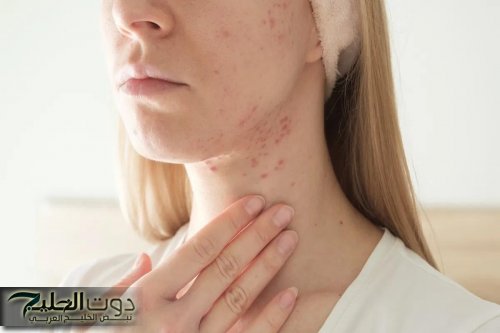 طرق طبيعية للتخلص من حب الشباب باستخدام مكونات منزلية بسيطة