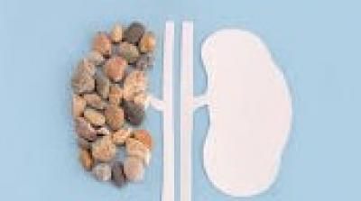 5 طرق علاجية في المنزل للتخلص من حصوات الكلى.. تعرف عليها