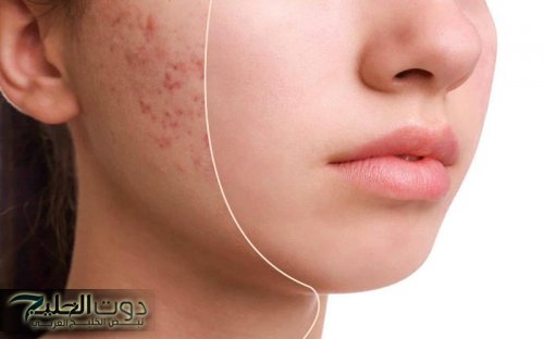 عطار ابن حلال قالي عليها.. 5 وصفات للتخلص من الندبات بطريقة طبيعية وآمنة بدون طبيب