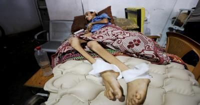 أخبار اليمن : صحة غزة: تسجيل 45 حالة شلل رخو حاد