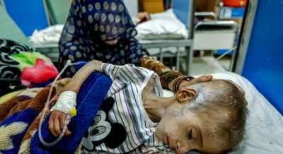 أخبار اليمن : وفاة 60 طفلاً نتيجة سوء التغذية في غزة