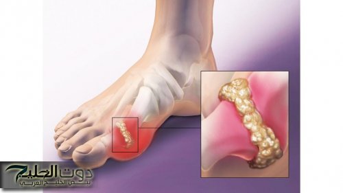 "كارثة صامتة داخل جسمك".. 10 أمراض تسبب زيادة حمض البوليك رقم 3 يصيب الملايين