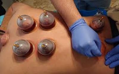 تعرف على أبرز فوائد العلاج بالحجامة