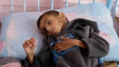 أخبار اليمن : ارتفاع الوفيات بسبب المجاعة في غزة إلى 162