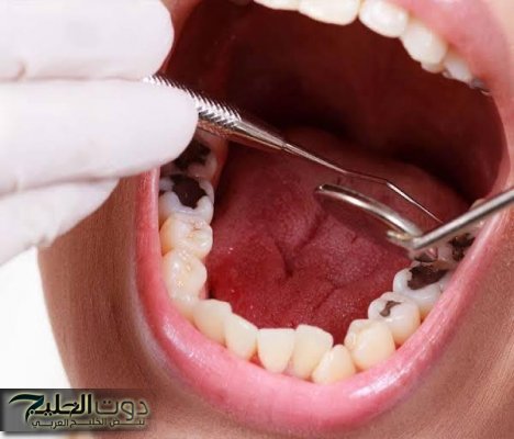 "دراسة تحذر فورًا" .. تسوس الأسنان قد يصيبك بمرض خطير .. ما هو؟؟؟