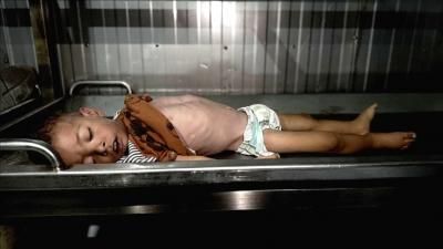 أخبار اليمن : 3 وفيات بمتلازمة "غيلان باريه" في غزة