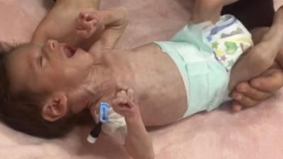 أخبار اليمن : غزة تشهد أعلى معدل شهري لسوء التغذية الحاد