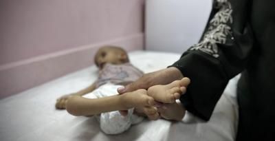 أخبار اليمن : ارتفاع شهداء التجويع بغزة إلى 201