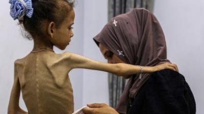أخبار اليمن : 5 وفيات جديدة بسبب المجاعة في غزة