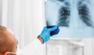 علاج مبتكر لسرطان الرئة بنسبة نجاح 90%