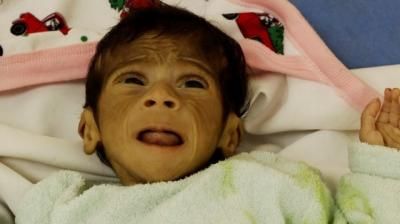 أخبار اليمن : 112 طفلاً يدخلون دائرة سوء التغذية يومياً في غزة