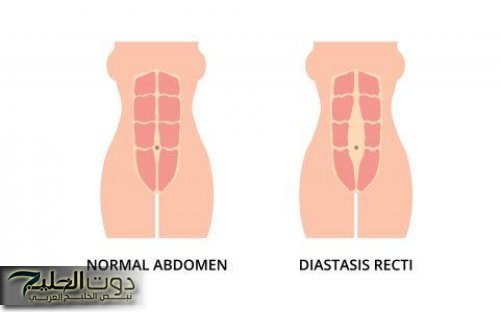 "تخيلي طلع مش كرش!" الانفصال العضلي ما هو وكيفية علاجه بالتمارين الرياضية