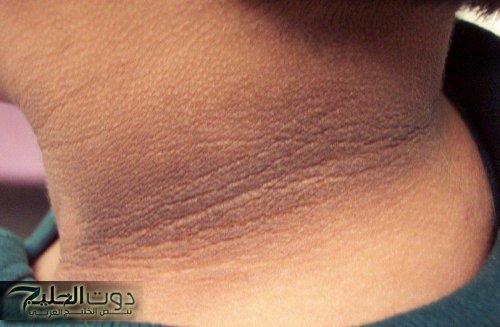احذروا.. علامات الإسمرار فى الرقبة لمن لديه هذه العلامات أحذر فهى تدل على مرض خطير ليس له علاج