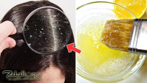 مكون طبيعي للتخلص من قشرة الشعر في أسبوع