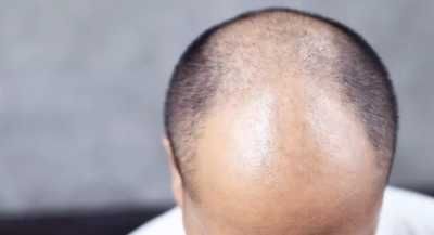 سبب غير متوقع وراء إصابتك بالصلع!