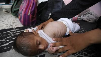 أخبار اليمن : 313 شهيداً جراء التجويع في غزة