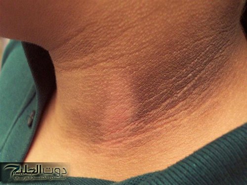 احذروا.. علامات الإسمرار فى الرقبة لمن لديه هذه العلامات أحذر فهى تدل على مرض خطير ليس له علاج