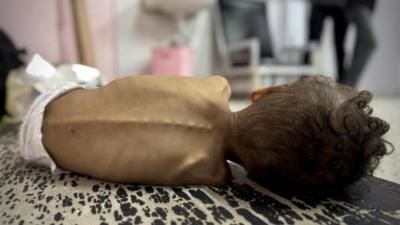 أخبار اليمن : 322 شهيداً جراء التجويع في غزة