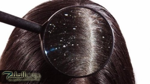 «مش هتحتاجي شامبوهات غالية!».. خلطة جبارة من مطبخك للتخلص من القشرة المستعصية بسرعة وتحافظ على نعومة ولمعان