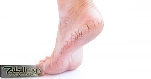 «السر الجمالي اللي كل ست لازم تعرفه!».. خلطة بسيطة من ملعقتين خل بس هتخلصك من تشققات الكعبين والجلد الغامق