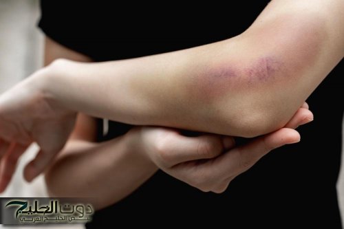 ليها سبب.. عوامل صحية وراء ظهور كدمات دون إصابة على جسمك
