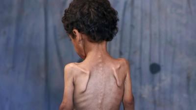 أخبار اليمن : 425 شهيداً جراء التجويع في غزة