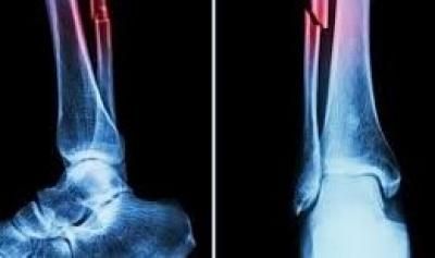 أخبار اليمن : ابتكار يعالج الكسور خلال 3 دقائق